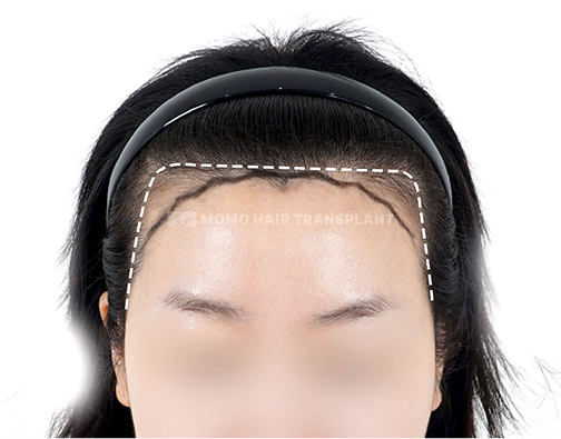 남성 비절개 모발이식 before