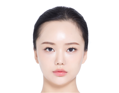 절개 모발이식 before