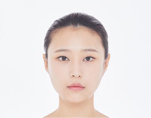 비절개 모발이식 before