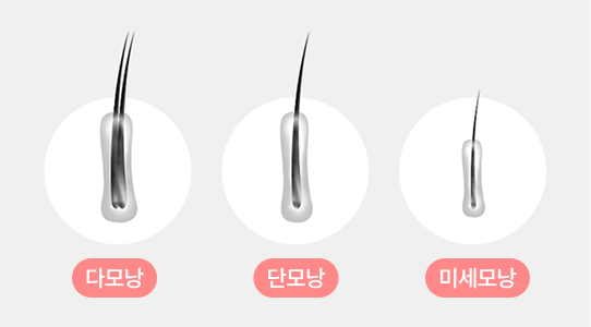 이마 그라데이션 이식