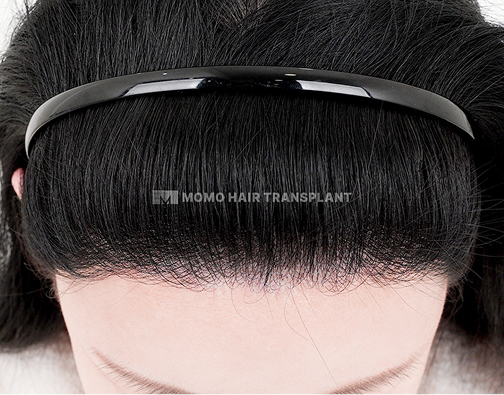 이마축소 흉터커버 절개 모발이식 after