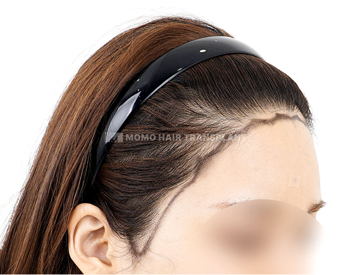 윤곽수술 흉터커버 비절개 모발이식 before