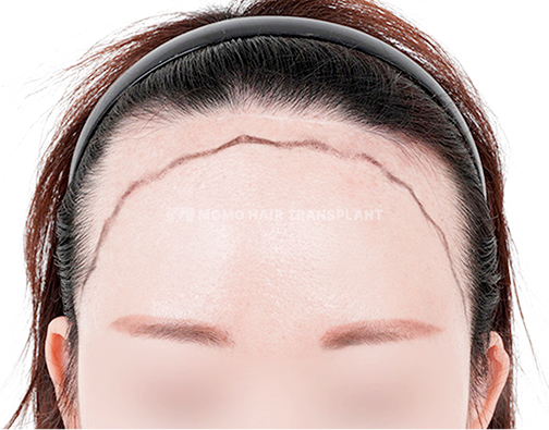 이마축소 흉터커버 절개 모발이식 before