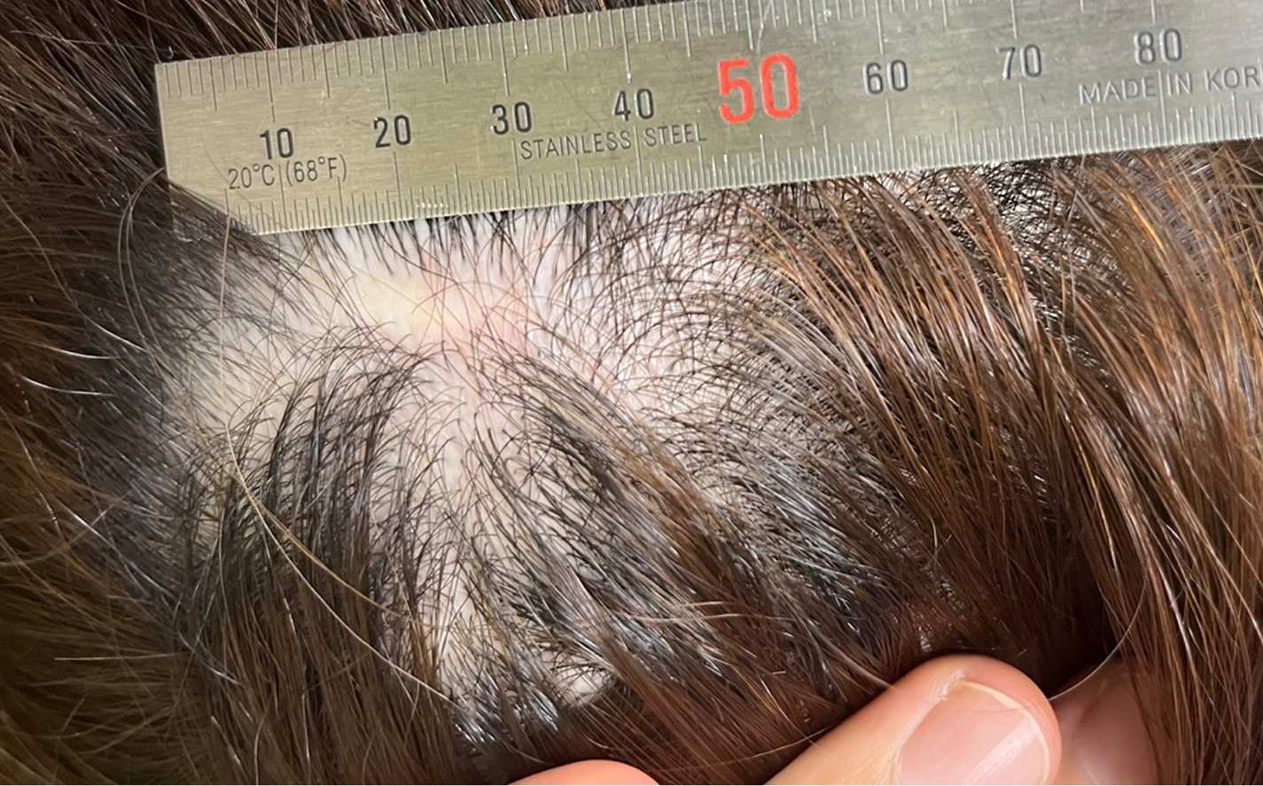 윤곽 수술 후 두피 절개 흉터