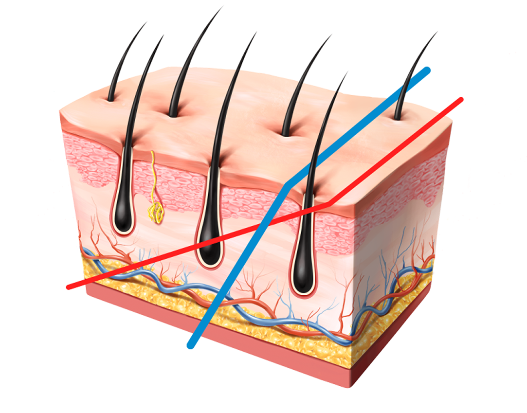 남성중심 디자인 절개 부위 탈모 / 흉터