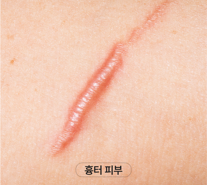 수술로 인한 헤어라인 변형