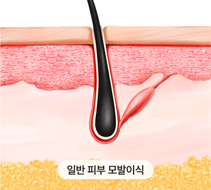 수술로 인한 헤어라인 변형
