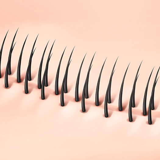 흉터커버 모발이식 수술 과정 02