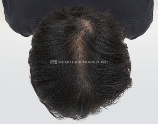 여성 정수리 모발이식 after
