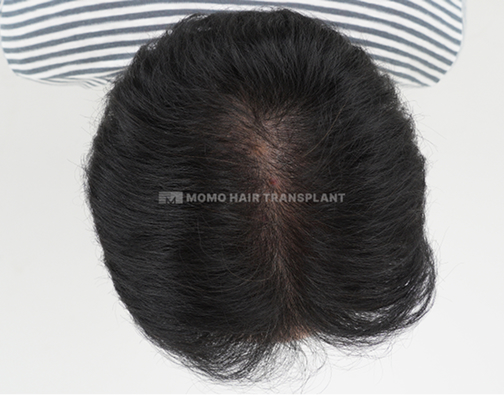 여성 정수리 모발이식 after