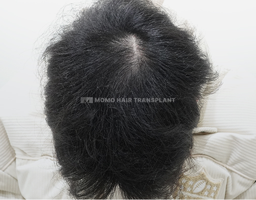 여성 이마거상 흉터커버 절개 after