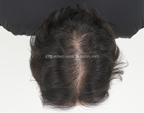 여성 이마거상 흉터커버 비절개 after