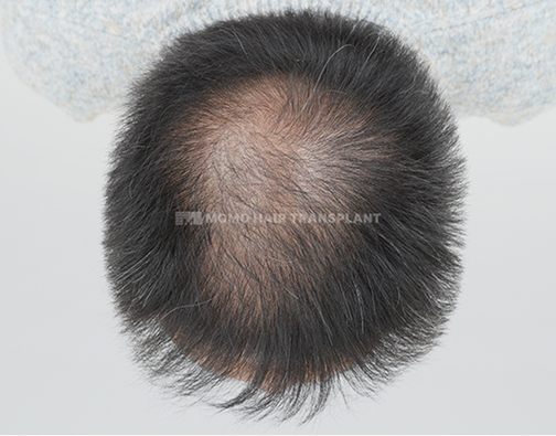 여성 정수리 모발이식 before