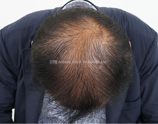 여성 이마거상 흉터커버 비절개 before