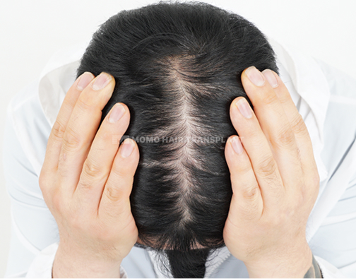 여성 이마거상 흉터커버 비절개 before