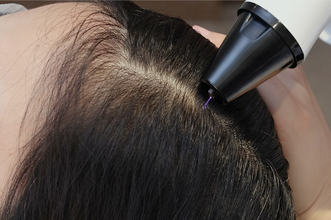 모낭 성장 인자 주입